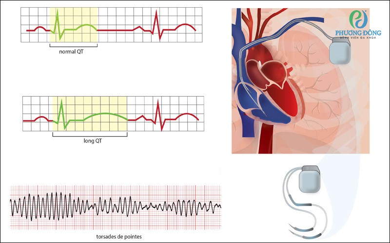 Phương pháp điều trị hội chứng QT kéo dài