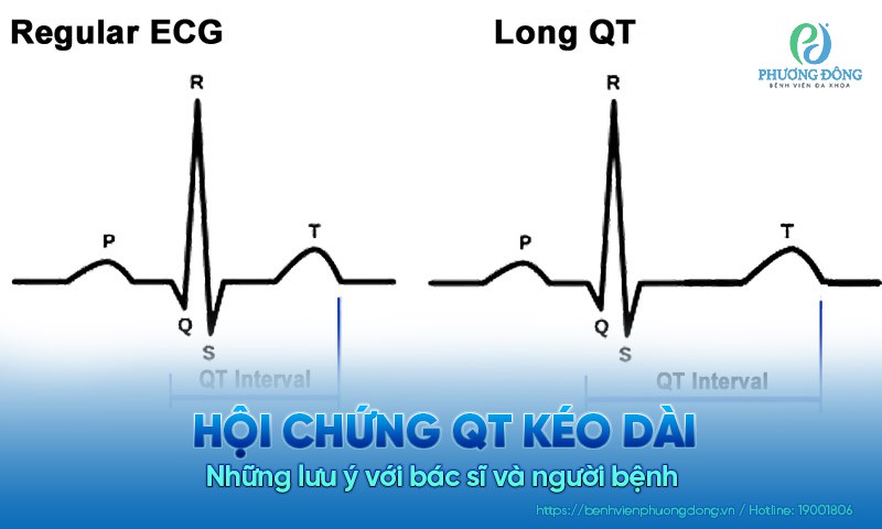 Hội chứng QT kéo dài – Những lưu ý với bác sĩ và người bệnh