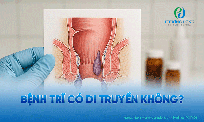 Bệnh trĩ có di truyền không?