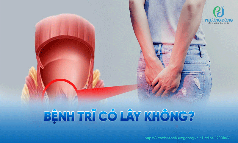Bệnh trĩ có lây không?