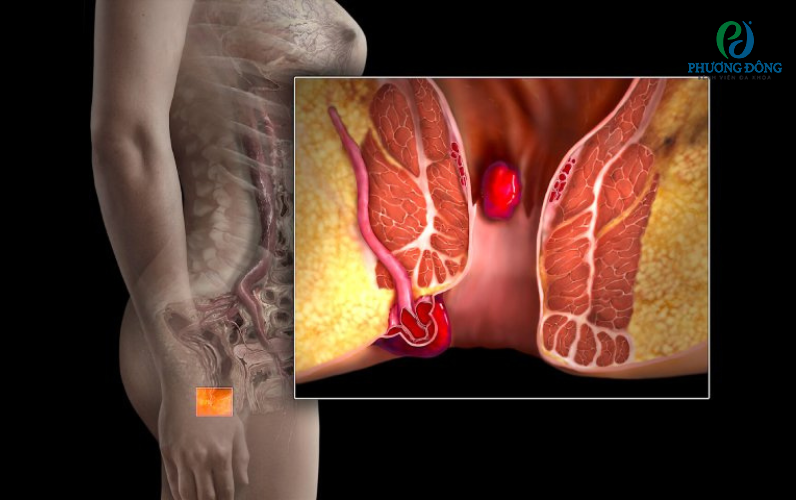 Bệnh trĩ có thể tự khỏi nếu bệnh ở giai đoạn nhẹ