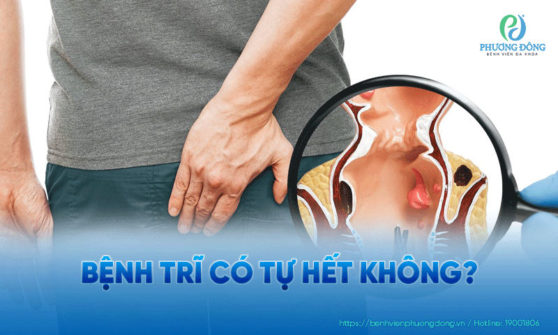 Bệnh trĩ có tự hết không?