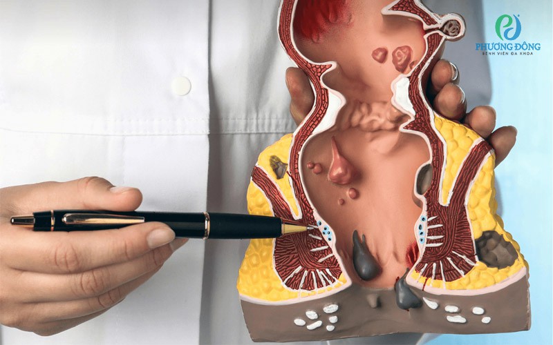 Tỷ lệ tái phát sau khi cắt trĩ vẫn có thể xảy ra tuỳ từng trường hợp