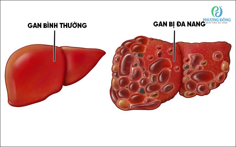 Nhận biết bệnh gan đa nang