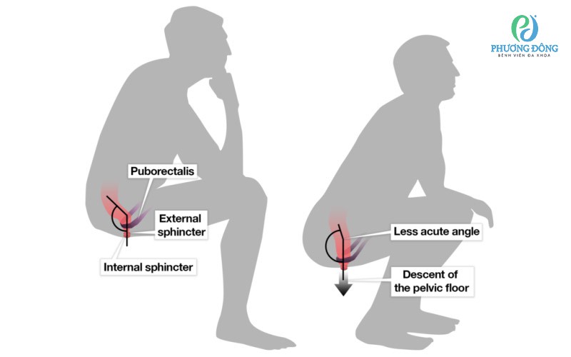 Ngồi xổm giúp bạn đi đại tiện dễ dàng hơn