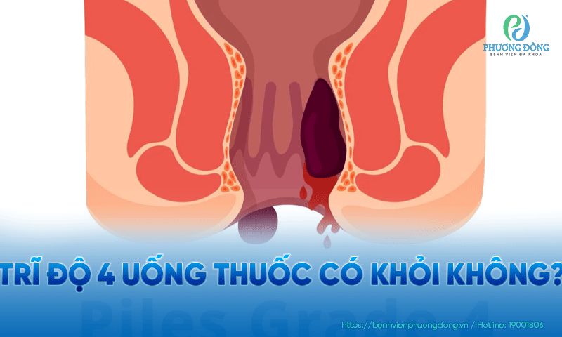 Trĩ độ 4 uống thuốc có khỏi không?