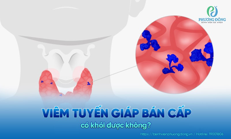 Viêm tuyến giáp bán cấp có khỏi được không?