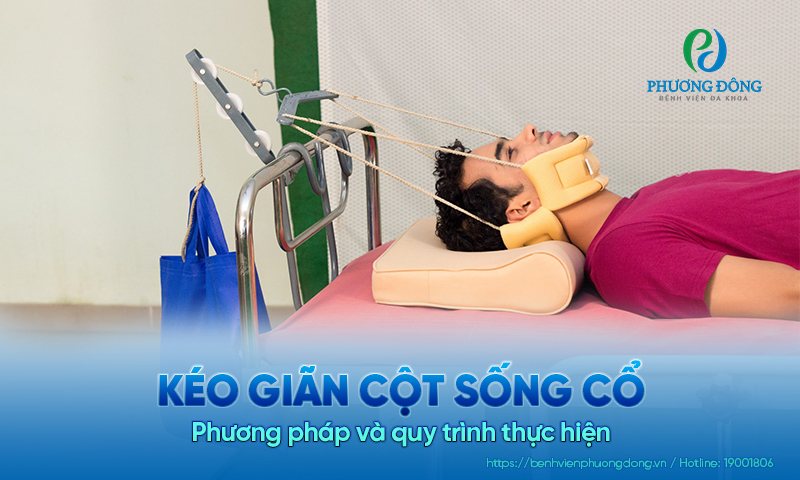 Kéo giãn cột sống cổ: Phương pháp và quy trình thực hiện
