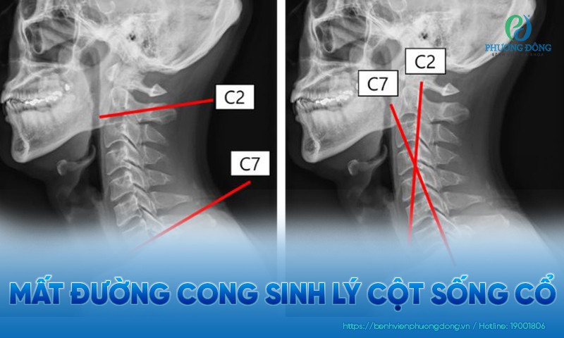 Mất đường cong sinh lý cột sống cổ: Nguyên nhân, triệu chứng và khắc phục