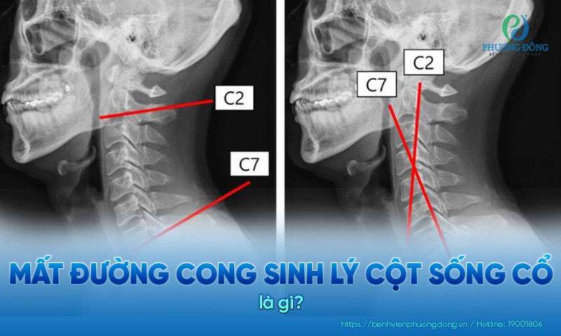 Hình ảnh mất đường cong sinh lý cột sống cổ