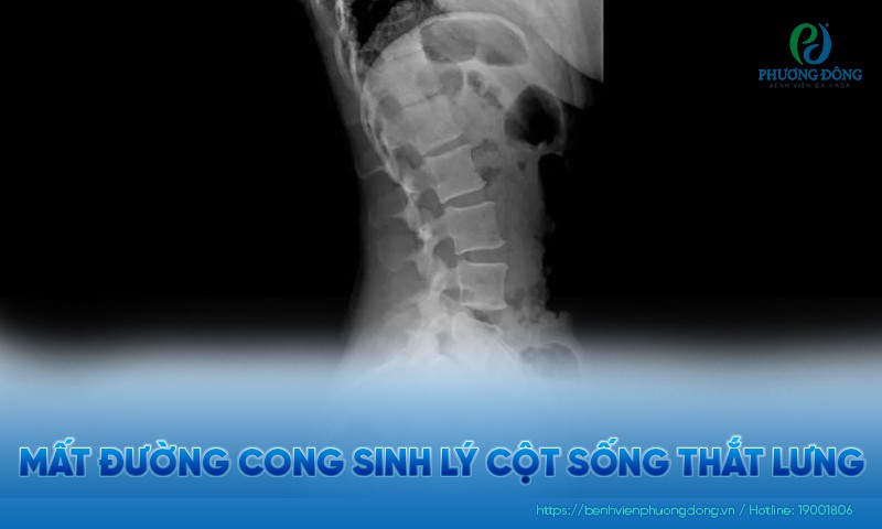 Mất đường cong sinh lý cột sống thắt lưng: Nguyên nhân, điều trị và phòng ngừa Mất đường cong sinh lý cột sống thắt lưng: Nguyên nhân, điều trị và phòng ngừa