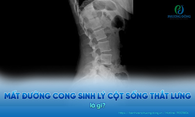 Hình ảnh mất đường cong sinh lý cột sống thắt lưng