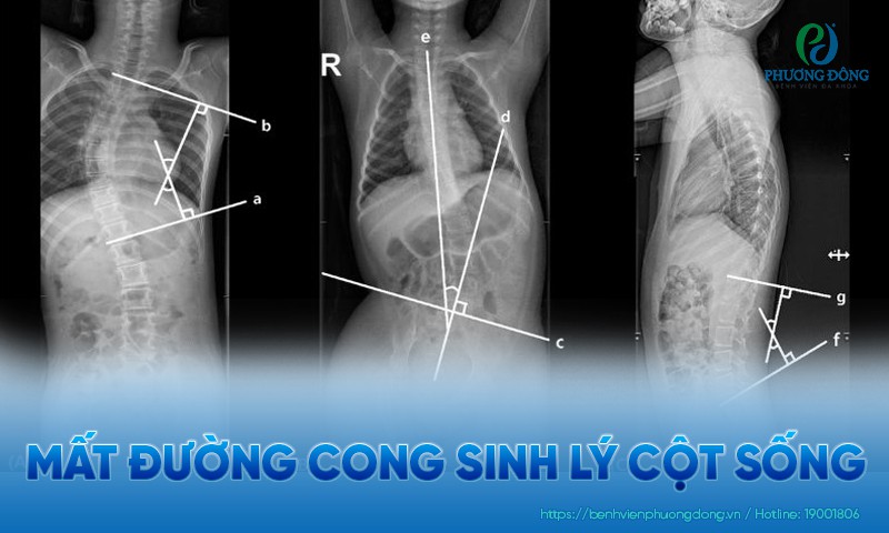 Mất đường cong sinh lý cột sống: Nguyên nhân và cách khắc phục