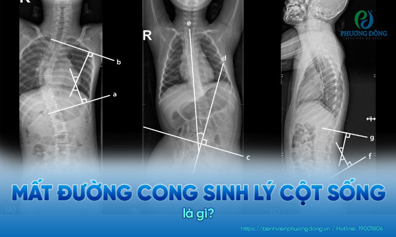 Mất đường cong sinh lý cột sống là tình trạng cấu trúc giải phẫu cột sống bị thay đổi