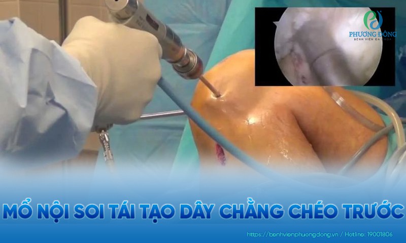 Mổ nội soi tái tạo dây chằng chéo trước: Ưu điểm, quy trình và chi phí