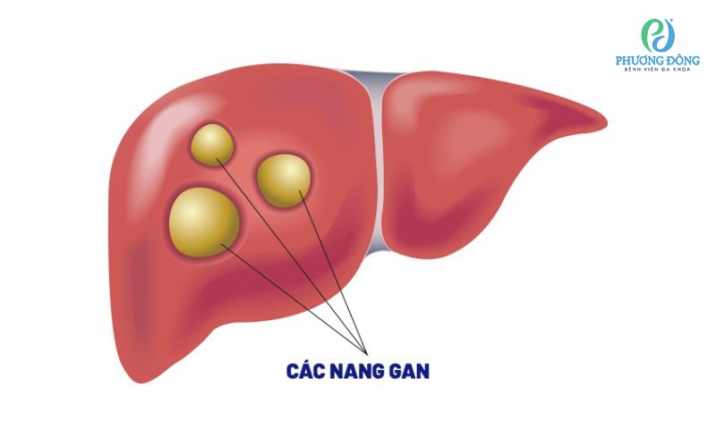 Nang gan: Nguyên nhân, triệu chứng và phương pháp điều trị