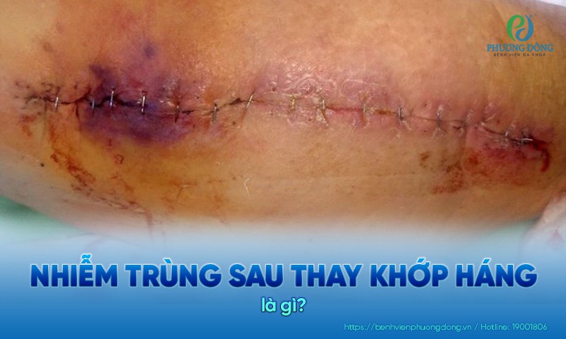 Nhiễm trùng sau thay khớp háng nhân tạo là một trong những biến chứng nguy hiểm