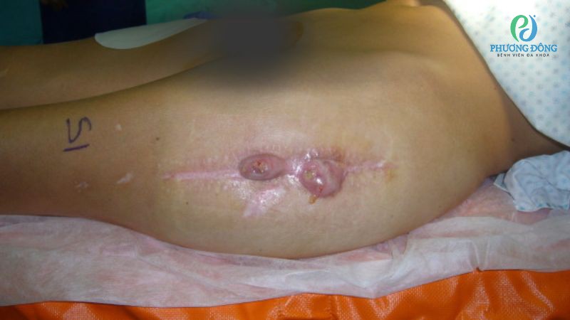 Phân loại độ nhiễm trùng dựa vào mục đích điều trị