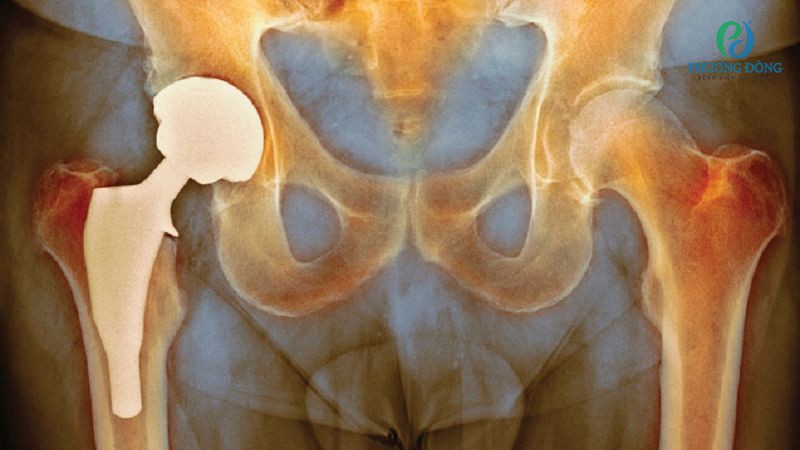 Hướng điều trị qua một thì mổ với biến chứng nhiễm trùng