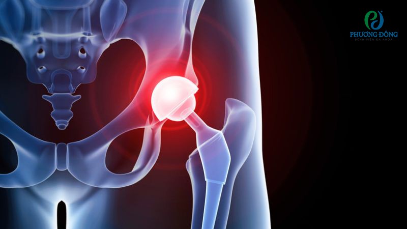 Phòng ngừa biến chứng nhiễm trùng hậu phẫu khớp háng nhân tạo