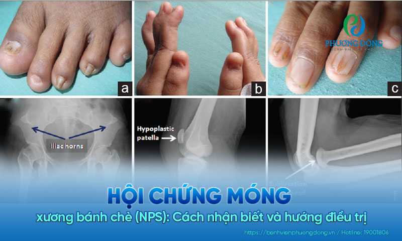 Hội chứng móng xương bánh chè (NPS): Cách nhận biết và hướng điều trị