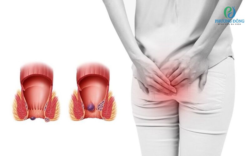Tổng hợp những cách phòng bệnh trĩ cho dân văn phòng hiệu quả 