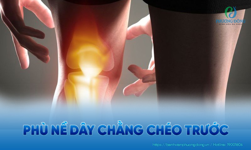 Phù nề dây chằng chéo trước: Triệu chứng, điều trị và phòng ngừa Phù nề dây chằng chéo trước: Triệu chứng, điều trị và phòng ngừa