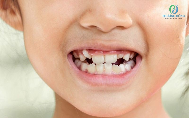 Răng bị lòi xỉ là gì? Nguyên nhân và cách khắc phục tình trạng
