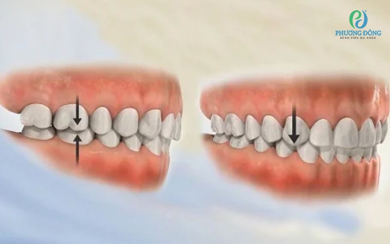 Sai khớp cắn loại 1 là gì? Nguyên nhân và phương pháp điều trị