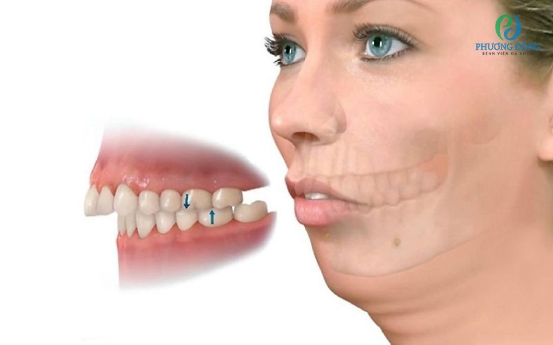 Tìm hiểu về sai khớp cắn loại 2: Nguyên nhân và cách điều trị