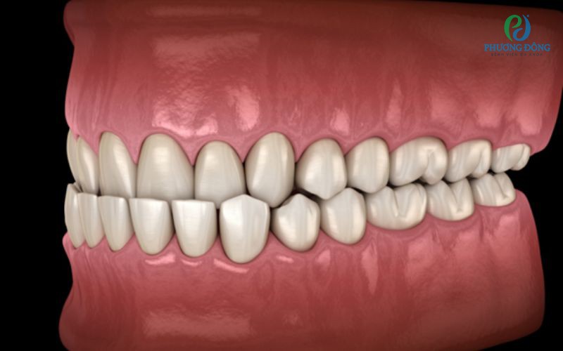 Sai khớp cắn loại 3: Nguyên nhân và cách điều trị 
