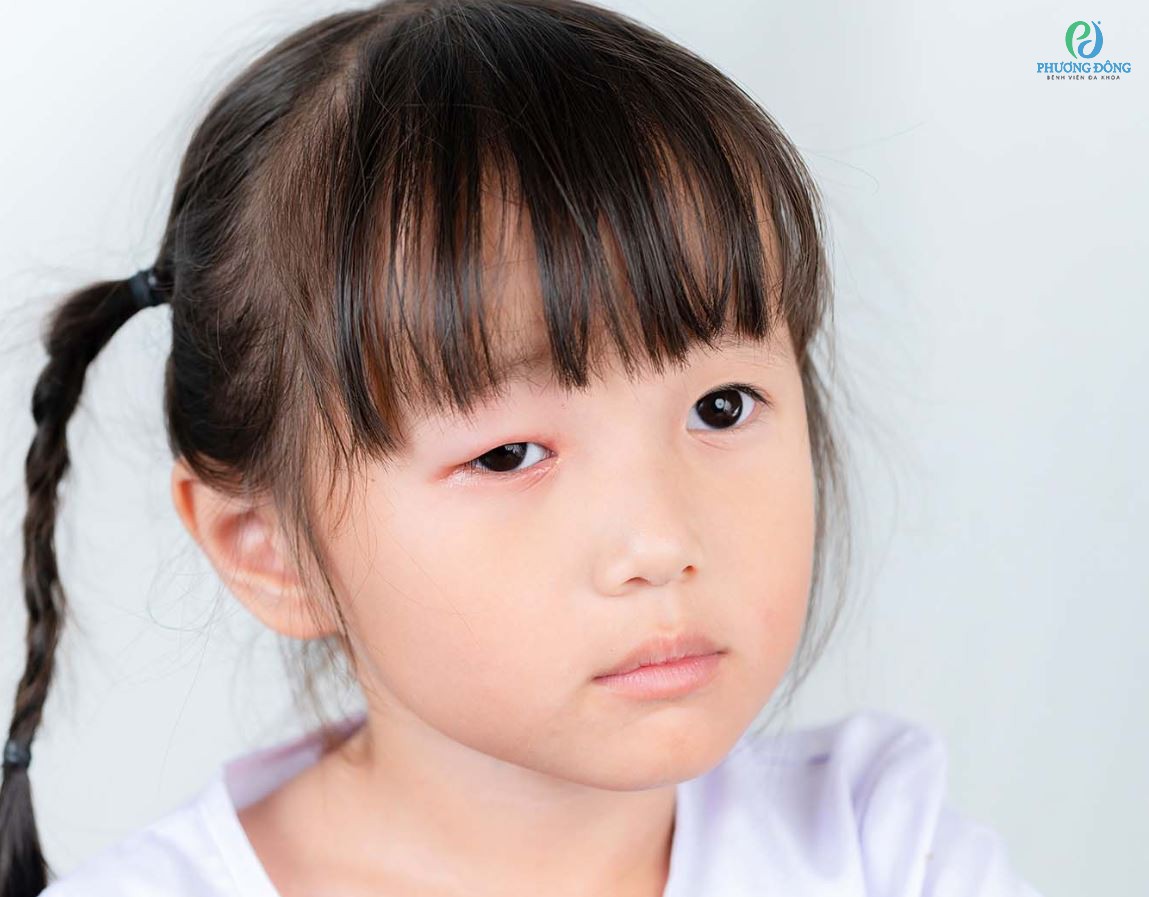 Sụp mí và những điều cần biết về bệnh