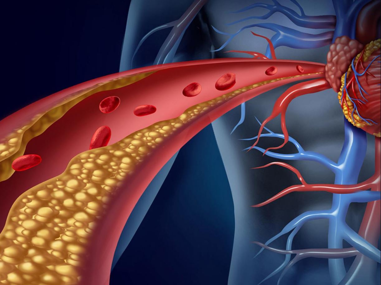 Tăng cholesterol máu có tính chất gia đình (FH)  Tăng cholesterol máu có tính chất gia đình (FH)