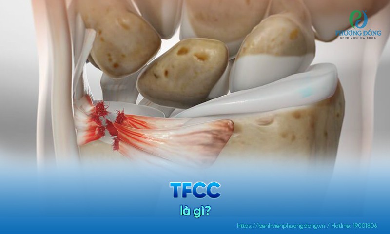 TFCC là gì? Triệu chứng, nguyên nhân và điều trị chấn thương