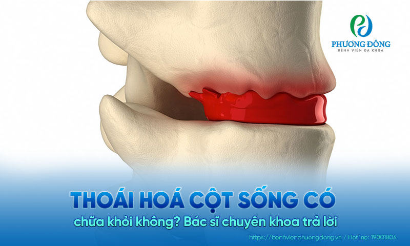 Bác sĩ chuyên khoa trả lời: Thoái hoá cột sống có chữa khỏi không? Bác sĩ chuyên khoa trả lời: Thoái hoá cột sống có chữa khỏi không?