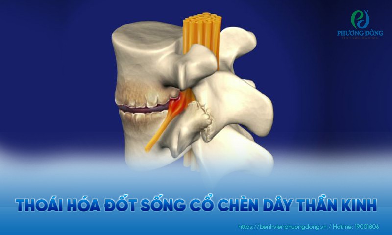 Thoái hóa đốt sống cổ chèn dây thần kinh có nguy hiểm không? Hướng điều trị