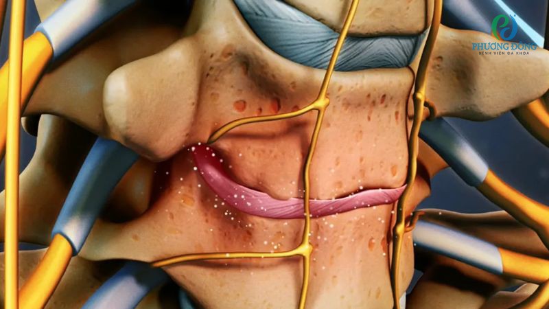 Nhóm yếu tố làm tăng nguy cơ đốt sống cổ thoái hóa chèn ép dây thần kinh