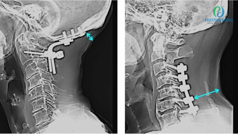 Điều trị tình trạng thoái hóa cột sống cổ chèn dây thần kinh