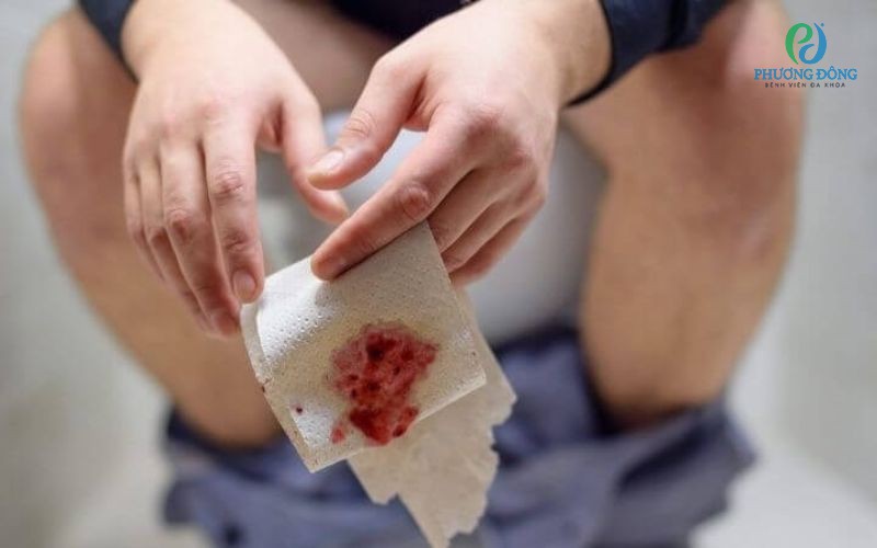 Búi trĩ chảy máu có sao không? Phương pháp điều trị bệnh hiệu quả