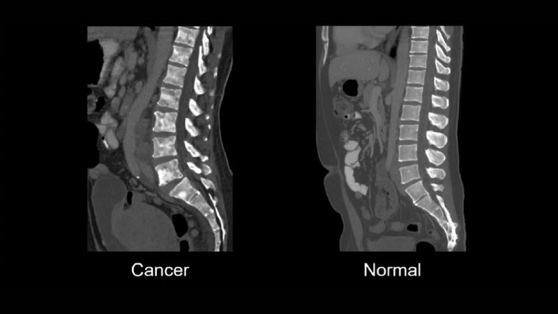 Người bệnh có thể được chỉ định chụp CT để phát hiện sớm các bất thường ở xương