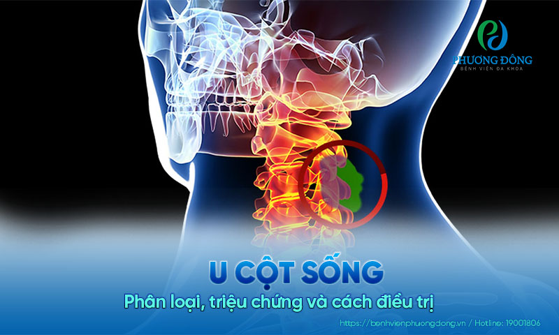 U cột sống: Phân loại, triệu chứng và cách điều trị U cột sống: Phân loại, triệu chứng và cách điều trị