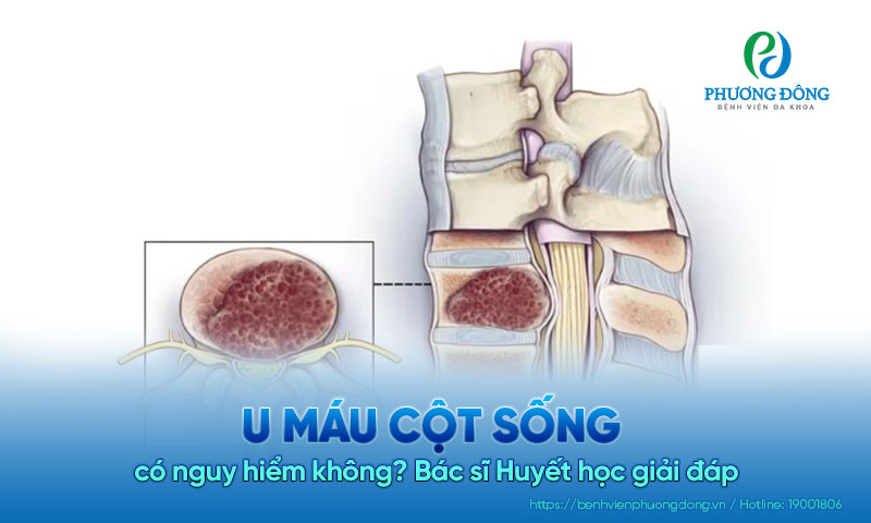 Bác sĩ Huyết học giải đáp: U máu cột sống có nguy hiểm không?  Bác sĩ Huyết học giải đáp: U máu cột sống có nguy hiểm không?
