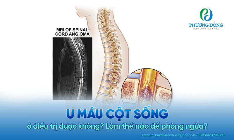 U máu cột sống có điều trị được không? Làm thế nào để phòng ngừa?