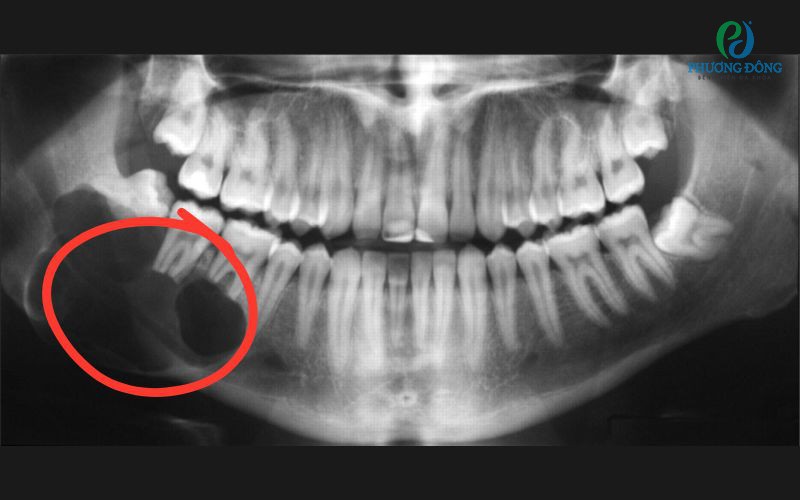 U men xương hàm: Nguyên nhân, triệu chứng và cách điều trị