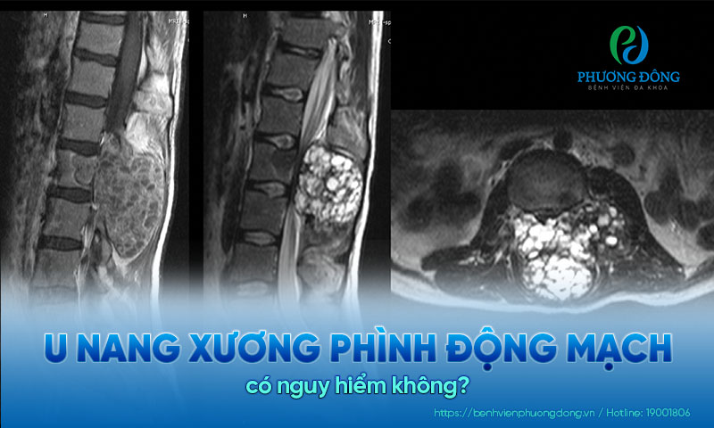 U nang xương phình động mạch có nguy hiểm không?