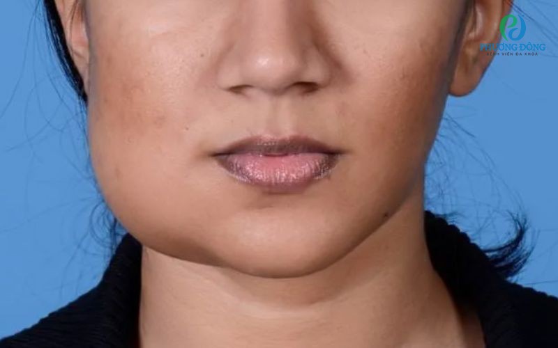 U xương hàm lành tính: Nguyên nhân, dấu hiệu nhận biết và cách điều trị