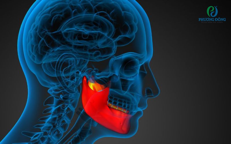 U xương hàm: Nguyên nhân, triệu chứng và cách điều trị