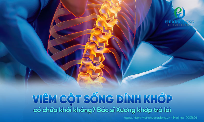 Bác sĩ Xương khớp trả lời: Viêm cột sống dính khớp có chữa khỏi không? Bác sĩ Xương khớp trả lời: Viêm cột sống dính khớp có chữa khỏi không?
