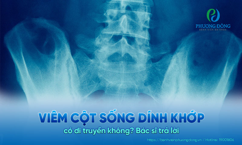 Hỏi đáp: Viêm cột sống dính khớp có di truyền không? Hỏi đáp: Viêm cột sống dính khớp có di truyền không?