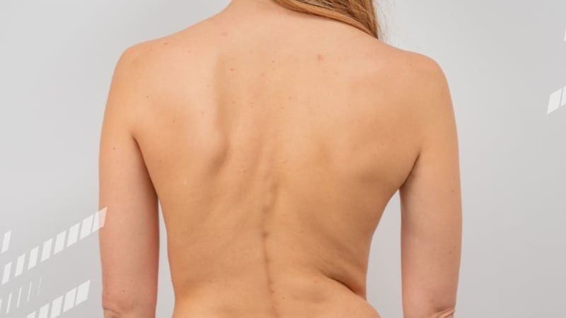 Bạn có thể bị gù vẹo cột sống nếu không điều trị sớm